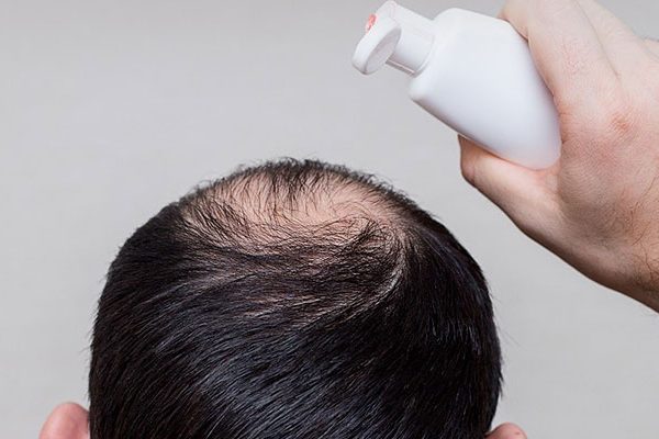 Is-It-Safe-to-Use-Nizoral-Shampoo-after-Recent-Hair-Transplant