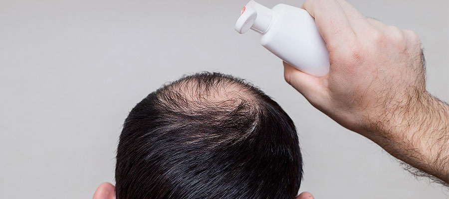 Is-It-Safe-to-Use-Nizoral-Shampoo-after-Recent-Hair-Transplant