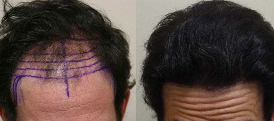 Toppik-After-Hair-Transplant