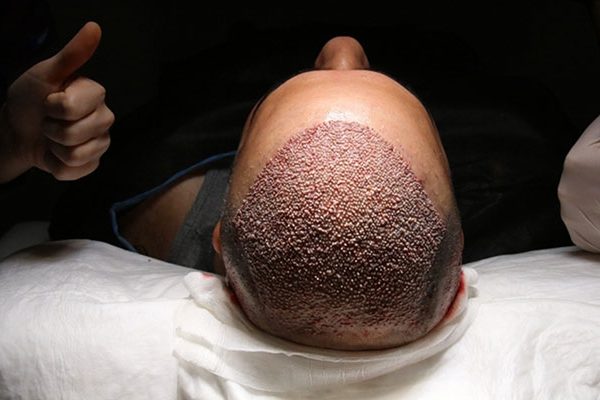 Bepanthol-Cream-Usage-After-A-Hair-Transplant