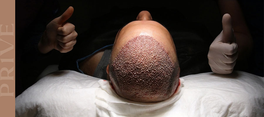 Bepanthol-Cream-Usage-After-A-Hair-Transplant