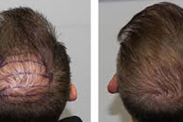 Head-Trauma-After-Hair-Transplant