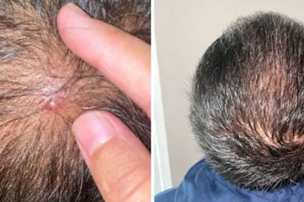 Pimples-After-Hair-Transplant-Surgery