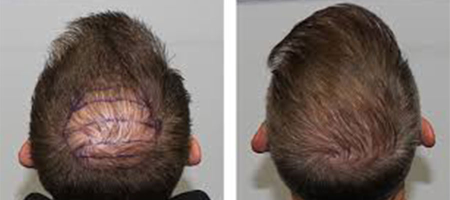 Head-Trauma-After-Hair-Transplant