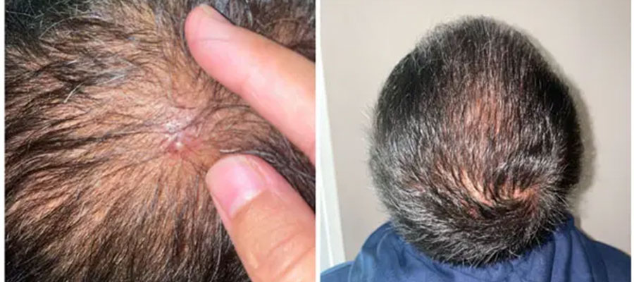 Pimples-After-Hair-Transplant-Surgery