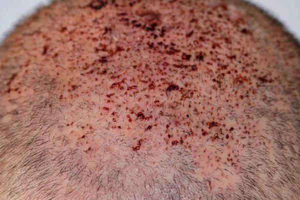 Does-vomiting-after-hair-transplant-cause-damage