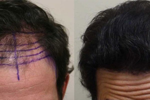 Toppik-After-Hair-Transplant