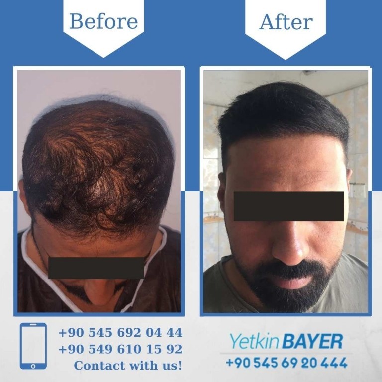 Hair Transplant Turkey Before & After - Dr. Bayer Clinics