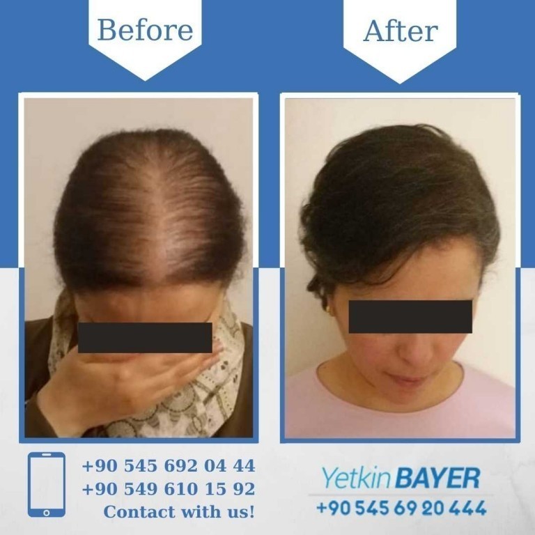 Female Hair Transplant In Istanbul, Turkey | Prices & Reviews 2023 | Dr ...