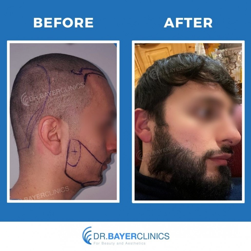 DHI-FUE Hair Transplant in Turkey- All-Inclusive Packages Save up to70%