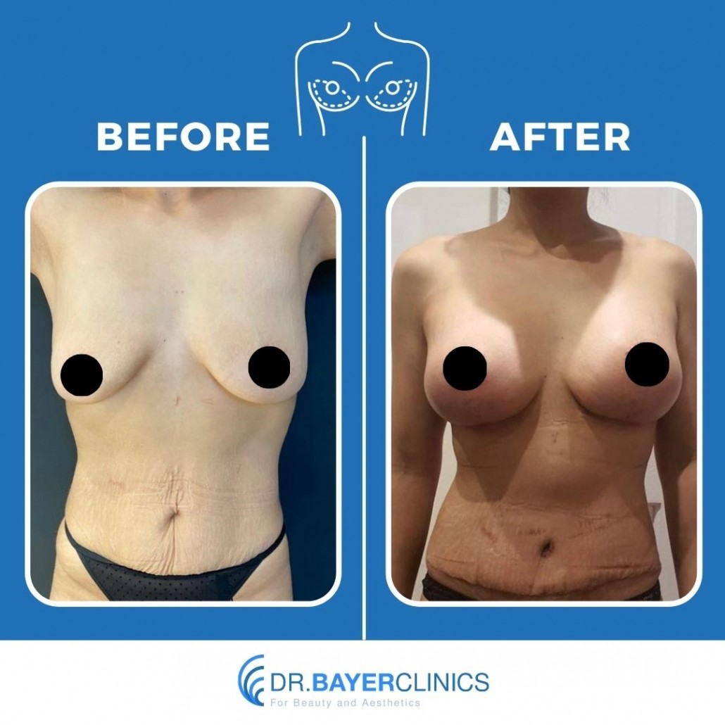 Breast Augmentation Before After Photos