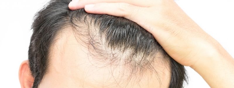 hair loss reasons signs hair transplant gomediran on is 1 hair transplant enough