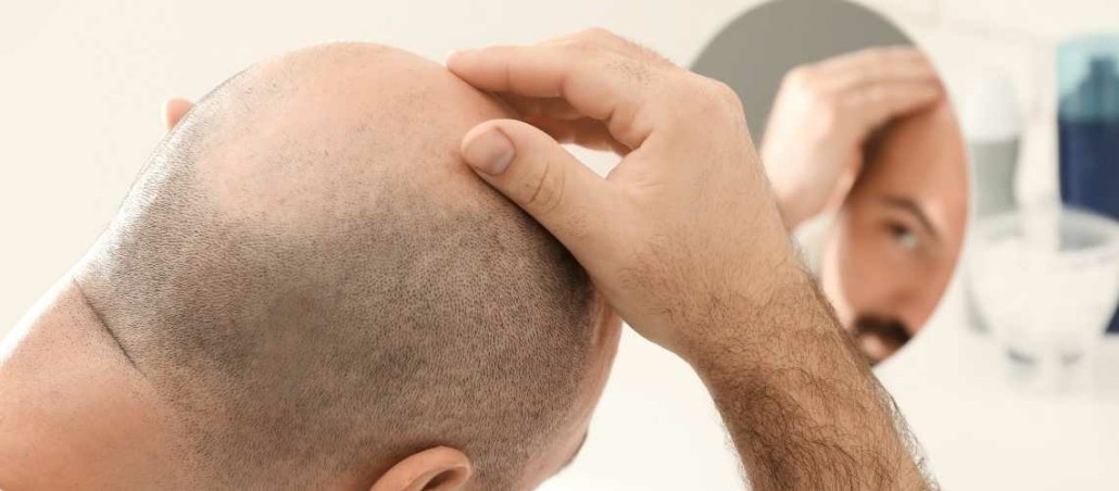 Er hårtransplantationsforum troværdigt?