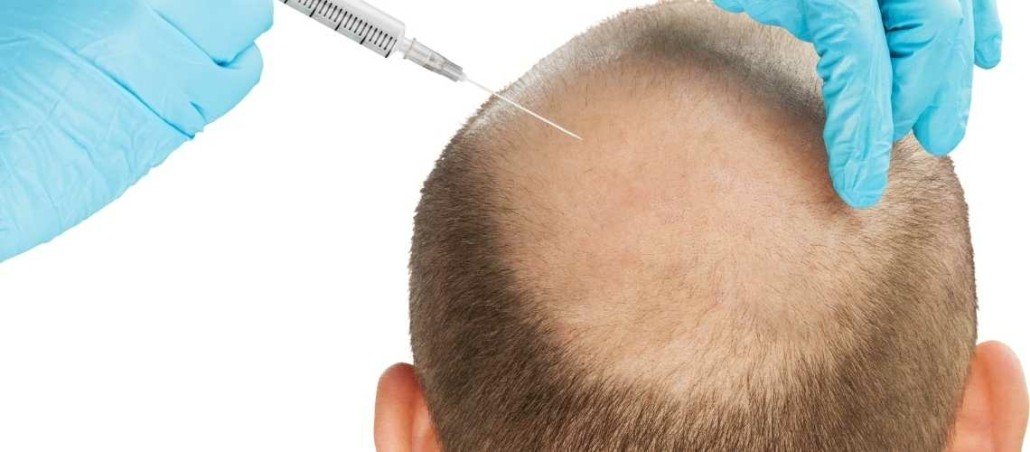 Gjør hårtransplantasjon vondt?