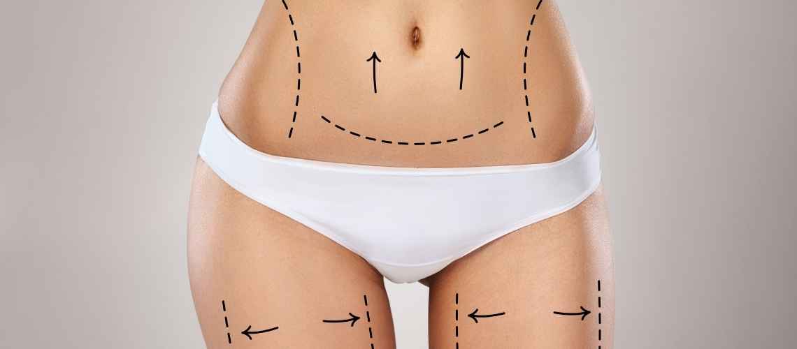 Mega Liposuction Before & After - Explore Our Procedures